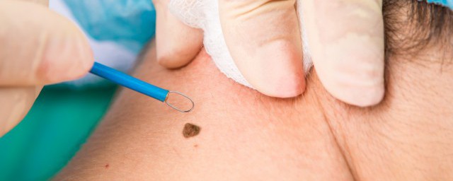 胸下有痣表示什么(胸上有痣的含义)