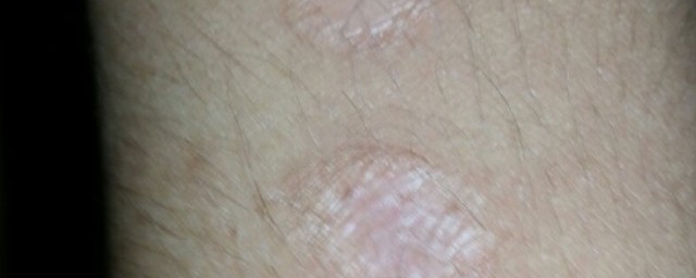 去除烟疤小妙招是什么(烟疤有什么办法可以去掉吗)