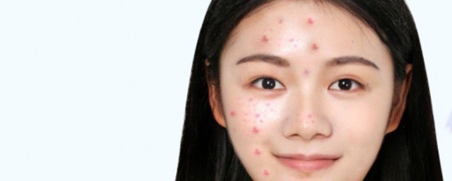 去除粉刺怎么护理(如何去除粉刺?)