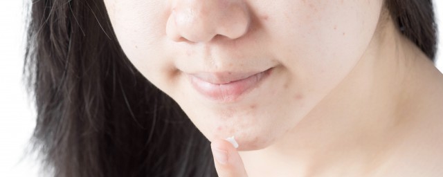 脖子长痘痘注意事项有哪些(脖子处长痘痘什么原因)