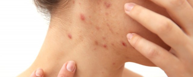 使用粉刺针要注意什么(什么样的粉刺可以用粉刺针)