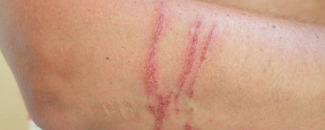 怎样去疤(怎样去疤痕生活小妙招)