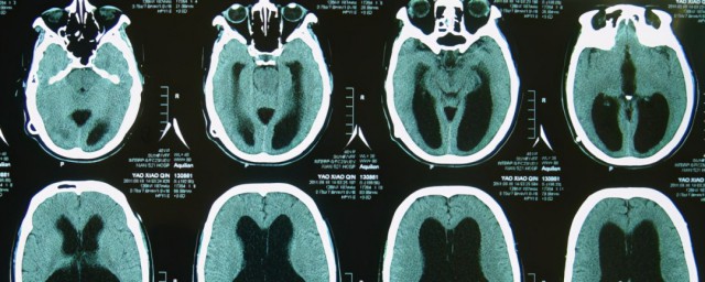 枕大池增大如何解释(枕大池变大)