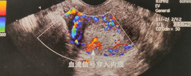 血流信号的意思(血流信号是干什么的)