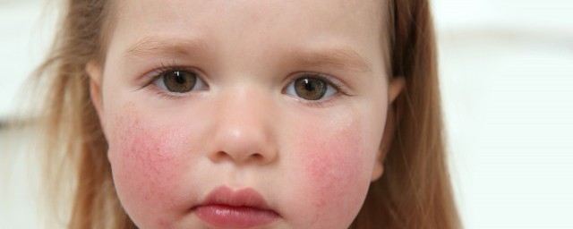 小孩眼睛痒怎么处理(小孩子眼睛痒是怎么回事怎么治疗)