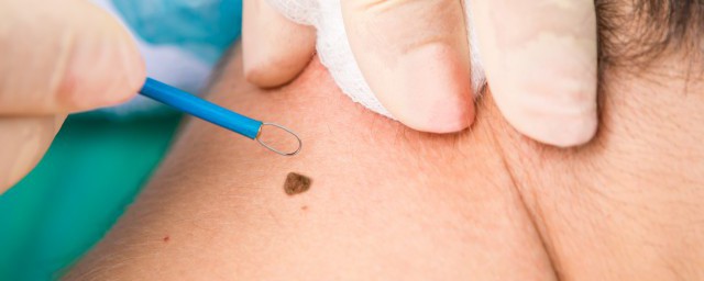 点完痣要注意的饮食和事项(点痣以后的饮食注意)