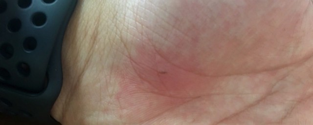 怎么去除手上刺(手上有刺怎么去除)