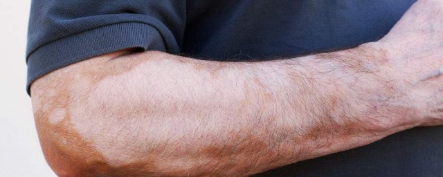 白癜风人群有什么共同点有什么