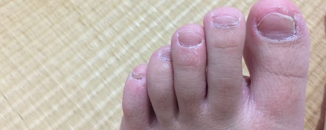脚趾甲碰到里面流血有没有关系吗(脚趾甲周围出血怎么回事)