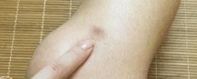 腿上莫名有淤青是不是被鬼掐的(腿上无故淤青不痛是鬼掐的)
