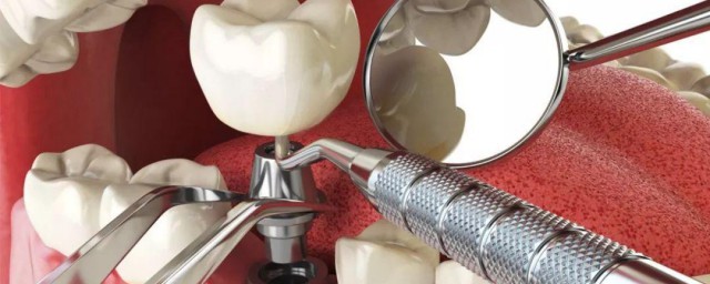 种植牙当天注意事项分享(种植牙全部完成后注意事项)