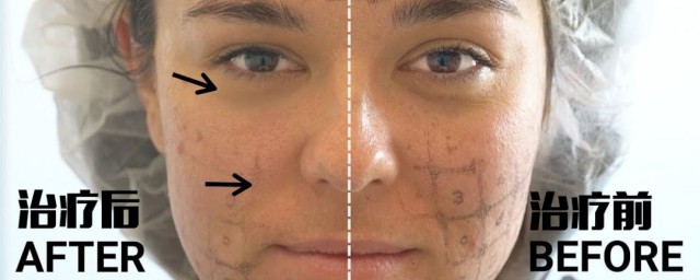 热玛吉的原理和功效是什么(热玛吉功效热玛吉的作用)