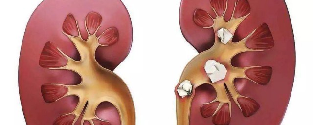 肾结石注意事项及饮食禁忌分享(肾结石日常饮食应该注意)