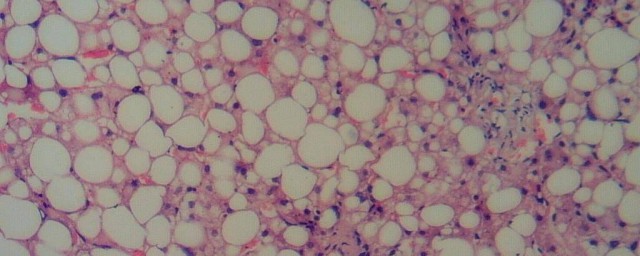 肝光点密集的意思(肝光点密集是怎么回事)