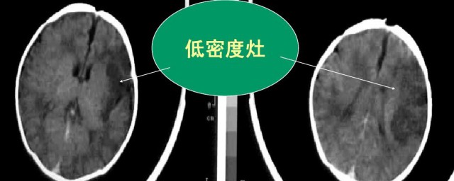 低密度灶的含义(低密度灶性质是什么意思)