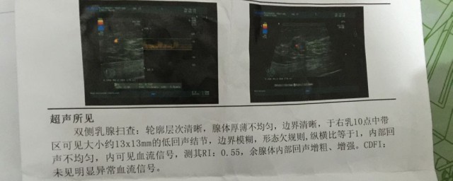 等回声结节什么的意思(等回声结节是良性吗)
