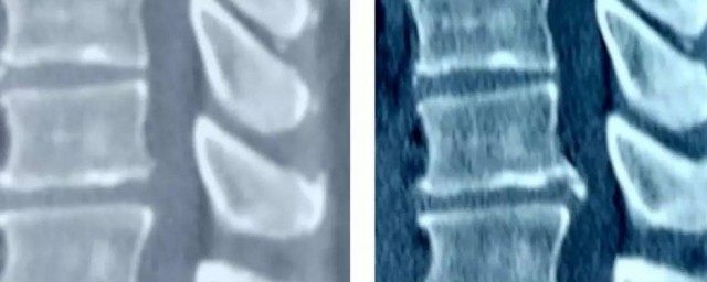 腰椎膨隆意思(腰椎膨隆和膨出有什么区别)