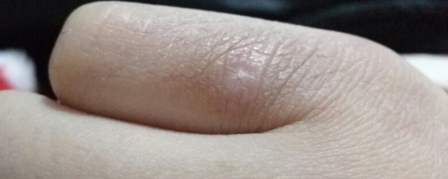 冻疮如何治(冻疮如何治疗冻疮能擦清凉油吗)