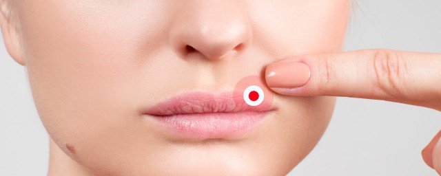 嘴角开裂处理的方法(嘴角边开裂怎么快速消除)