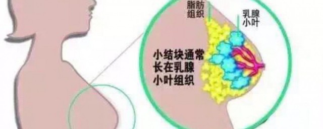 乳腺炎怎么办(轻微乳腺炎怎么办)