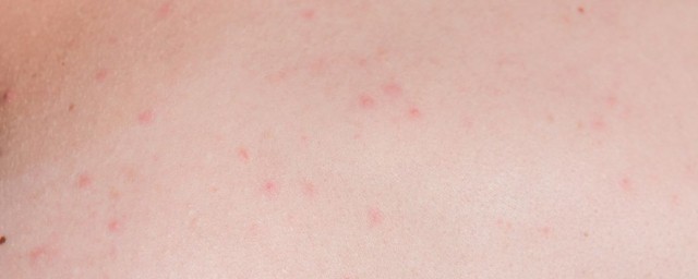 身上长痱子的解决方法(身上长瘊子怎么办如何治疗瘊子)