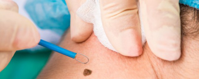 右眼泪痣代表啥意思(右眼角泪痣代表什么意思)