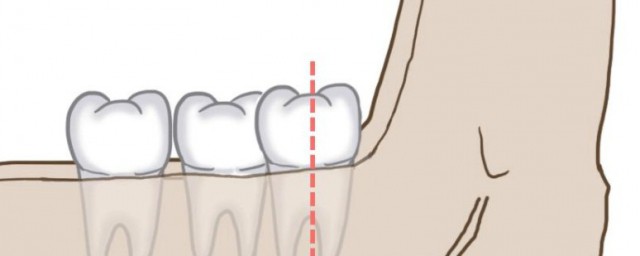 智齿会疼的原因(智齿疼啥原因)