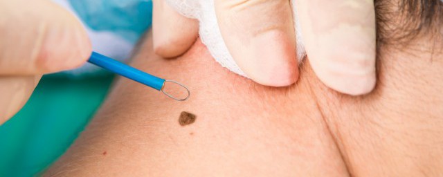 什么是水险痣(水险痣是凶是吉)