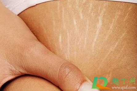 肥胖纹一辈子都去不掉吗(肥胖纹这辈子都消不了吗)