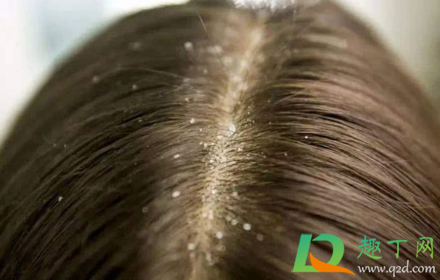 为什么冬天有头屑夏天就没了(夏天没有头皮屑冬天有头皮屑)