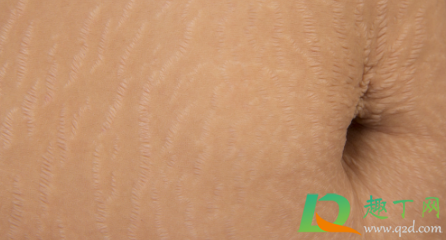 肥胖纹一辈子都去不掉吗(肥胖纹这辈子都消不了吗)