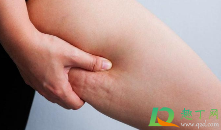 橘皮组织和肥胖没啥关系(橘皮组织跟肥胖纹是一回事吗)