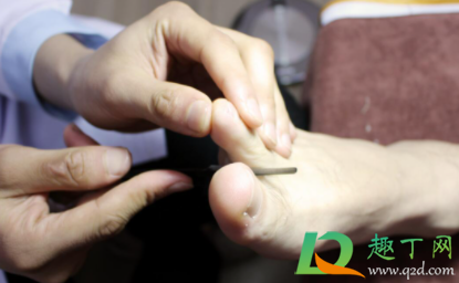 修脚会修成甲沟炎吗(修脚会加重甲沟炎嘛)