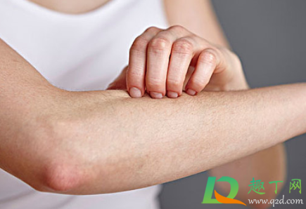 查过敏原麻烦吗(能查出过敏源吗) 查过敏原麻烦吗(能查出过敏源吗)