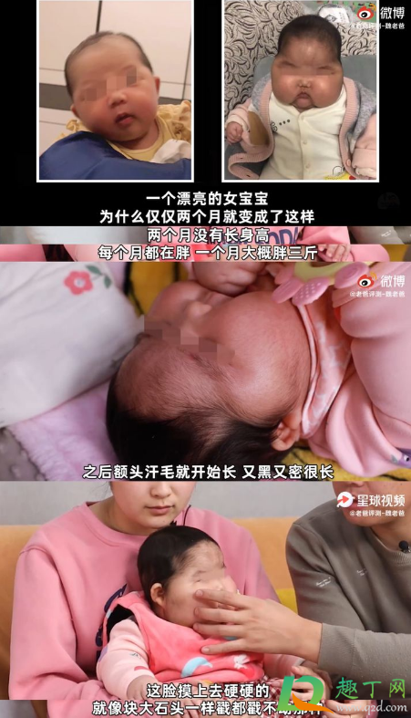 婴儿用抑菌霜后成大头娃娃真的吗(消费者报告|一款婴儿抑菌霜致“大头娃娃”)