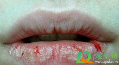 嘴唇干裂脱皮怎么办(夏天嘴唇干裂脱皮怎么办)