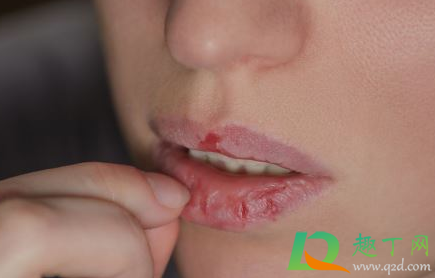 嘴唇干裂脱皮怎么办(夏天嘴唇干裂脱皮怎么办)