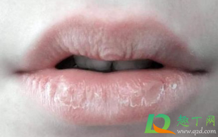 嘴唇干裂脱皮怎么办(夏天嘴唇干裂脱皮怎么办)