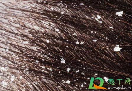 头皮有螨虫用什么可以治(头皮除螨用什么药)