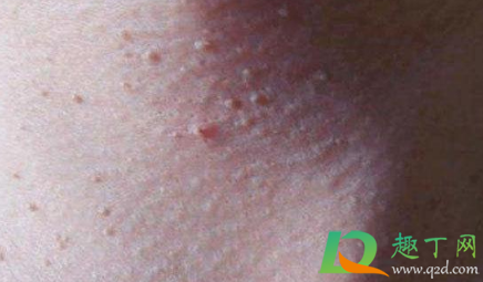 初期小疣体图片怎么治疗(有小疣体怎么办)