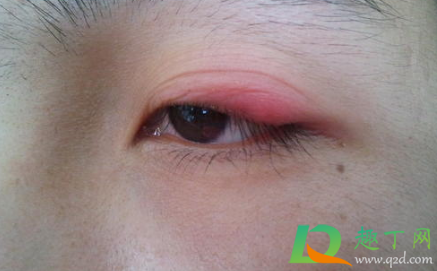 眼皮发痒红肿是咋回事(眼皮痒还红肿是怎么回事)
