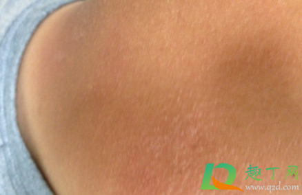 初期小疣体图片怎么治疗(有小疣体怎么办)