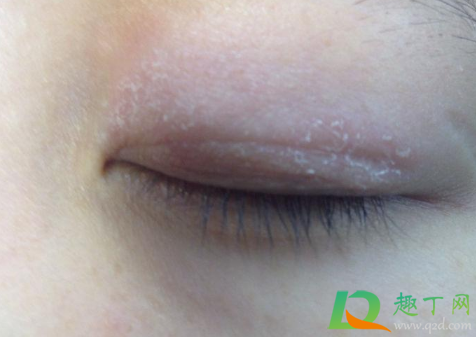 眼皮发痒红肿是咋回事(眼皮痒还红肿是怎么回事)