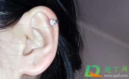 耳骨打耳洞长了个疙瘩怎么消除(打耳洞耳朵长疙瘩怎么办) 耳骨打耳洞长了个疙瘩怎么消除(打耳洞耳朵长疙瘩怎么办)