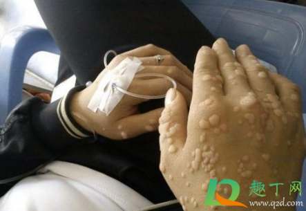 初期小疣体图片怎么治疗(有小疣体怎么办)