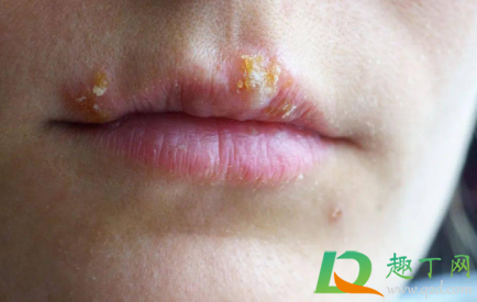 嘴唇老是干燥想舔是上火了吗(嘴唇干一直想舔嘴唇是什么原因) 嘴唇老是干燥想舔是上火了吗(嘴唇干一直想舔嘴唇是什么原因)