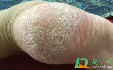 脚裂口子怎么办擦什么药(脚上裂口子抹什么药)