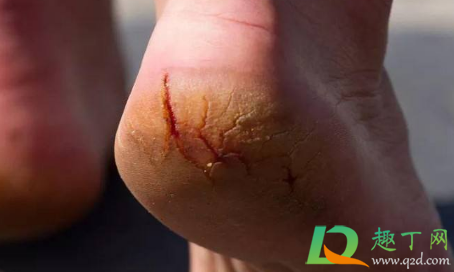 脚裂口子怎么办擦什么药(脚上裂口子抹什么药)