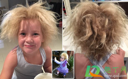 难梳头发综合症是什么东西(头发难梳理症) 难梳头发综合症是什么东西(头发难梳理症)