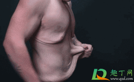 减肥后肚子上有赘皮怎么办(节食减肥后肚子上的赘皮很多)